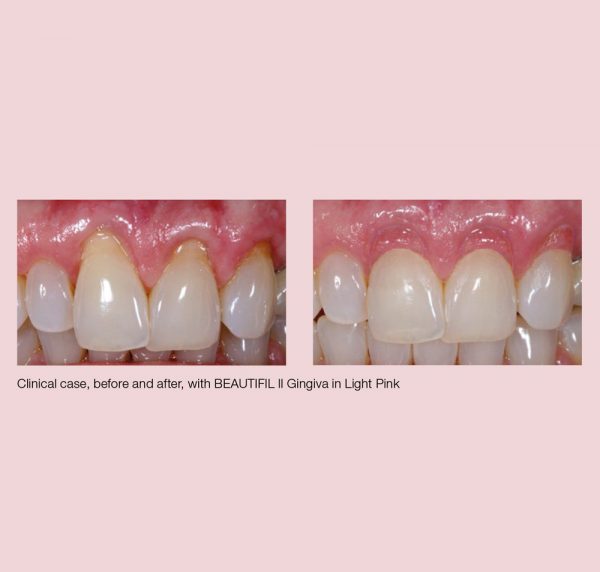 site gingiva